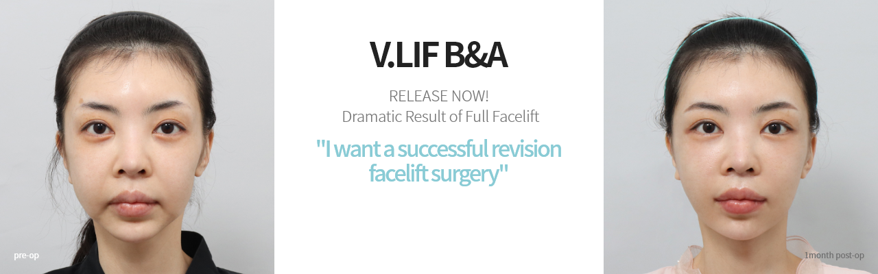 V.LIF B&A  빌리프를 경험한 분들의 드라마틱한 리프팅 효과를 지금 공개합니다! 안면거상재수술 성공하고싶어요