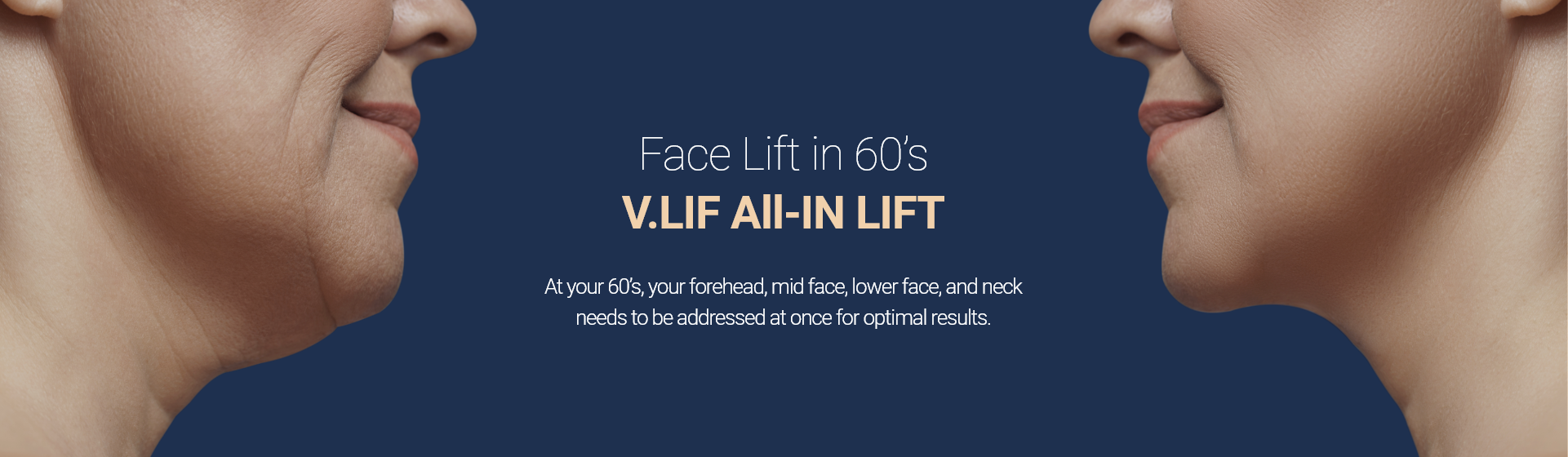 60대 안면거상술 빌리프 올인거상술 - 60대에는 안면뿐만 아니라, 목주름까지! 한번에 해결해야 됩니다.