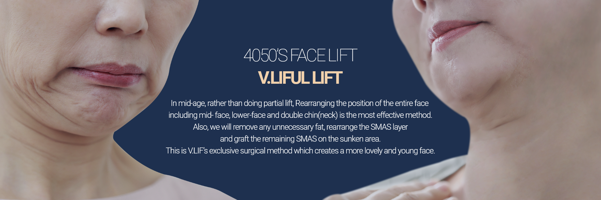 4050대 안면거상술 빌리풀거상 4050대에는 부분적으로 거상하는 방법이 아닌, 중안면부터, 하안면, 이중턱(목)까지 안면전체의 위치를 위로 재배치하는 것이 가장 효과적인 동안성형 방법입니다.