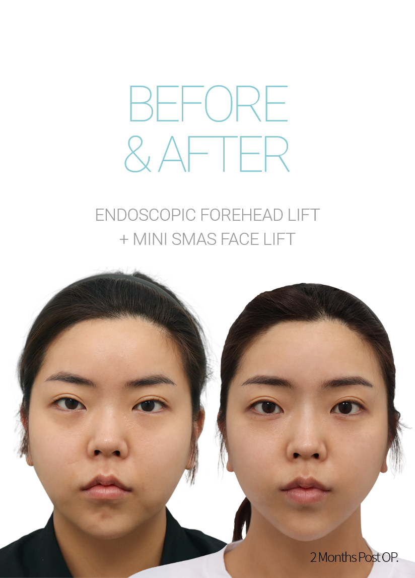 BEFORE & AFTER 픽업 내시경이마거상 + 미니거상