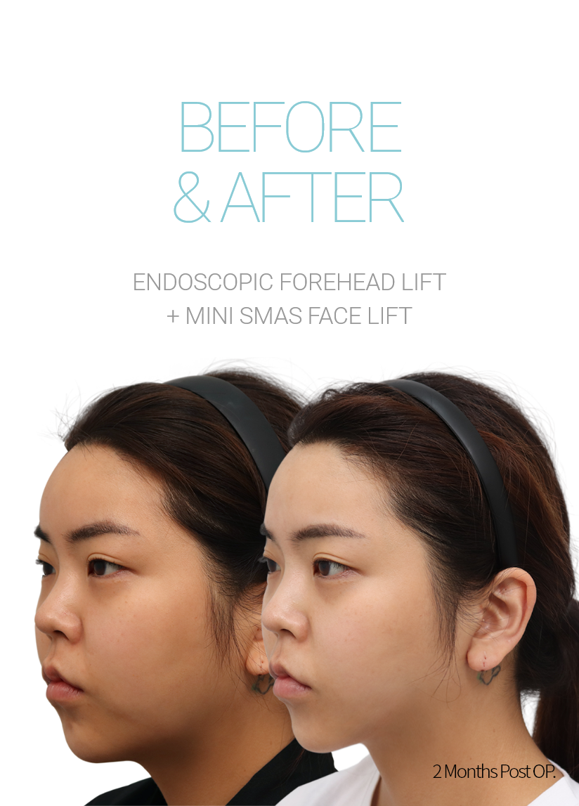 BEFORE & AFTER 픽업 내시경이마거상 + 미니거상