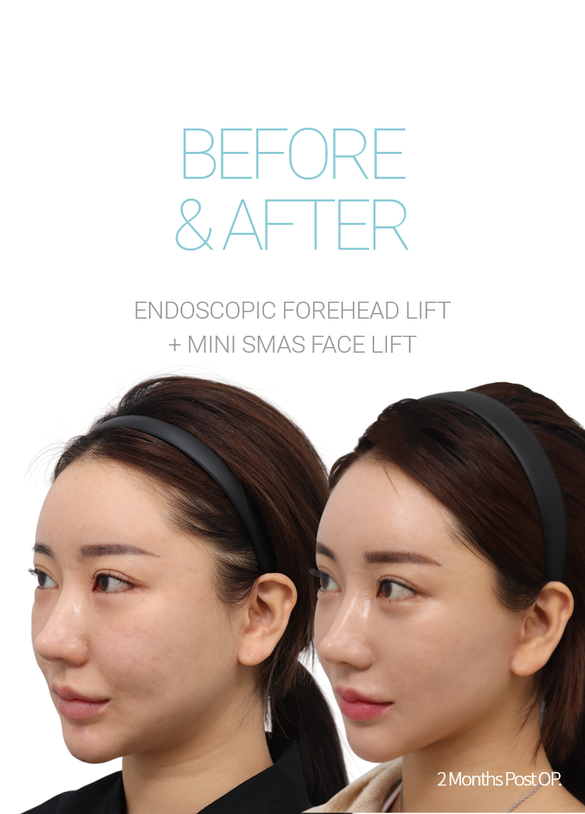 BEFORE & AFTER 픽업 내시경이마거상 + 미니거상