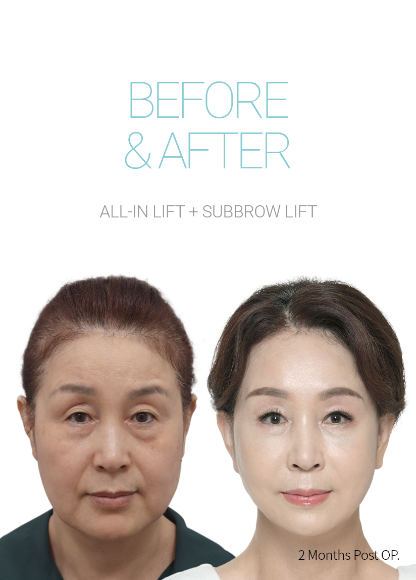 BEFORE & AFTER 픽업 내시경이마거상 + 올인거상 + 눈썹하거상