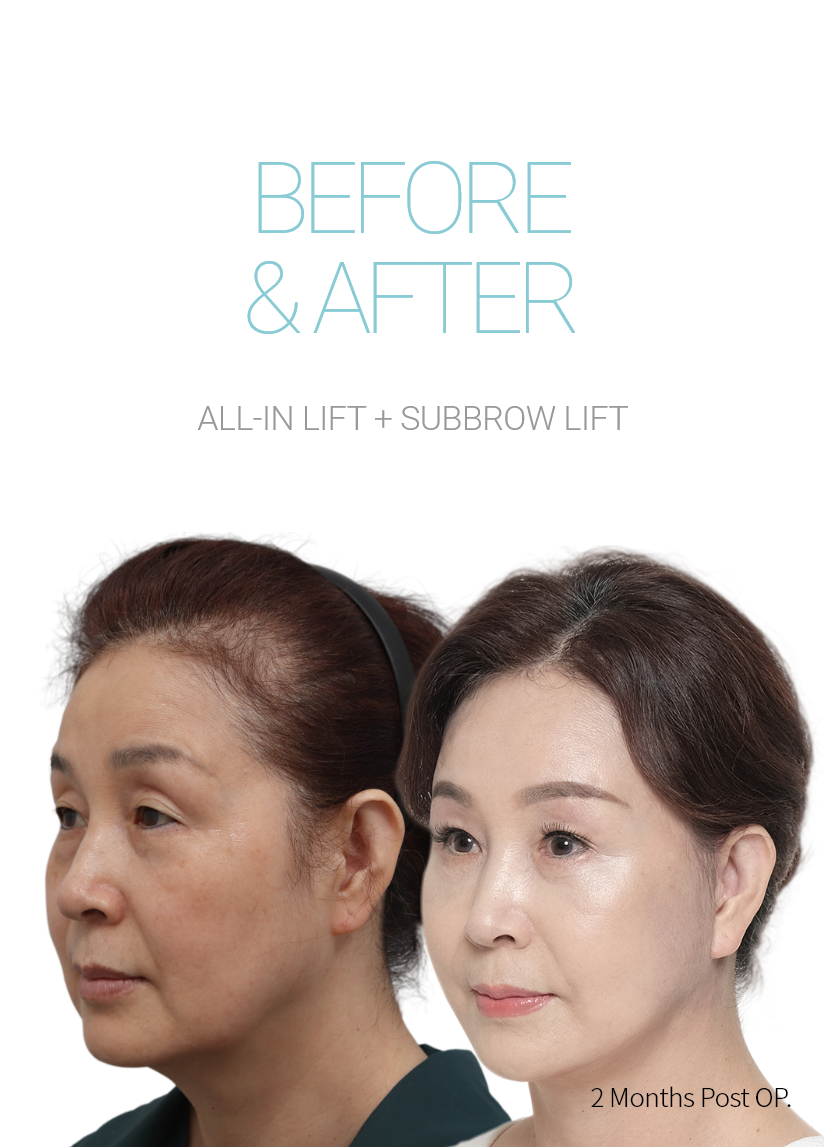 BEFORE & AFTER 픽업 내시경이마거상 + 올인거상 + 눈썹하거상