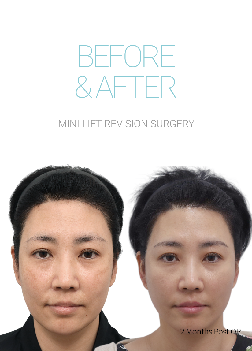 BEFORE & AFTER 미니거상재수술