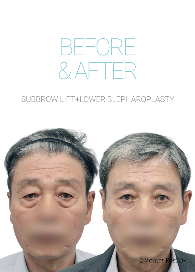 BEFORE & AFTER 눈썹하거상 + 하안검