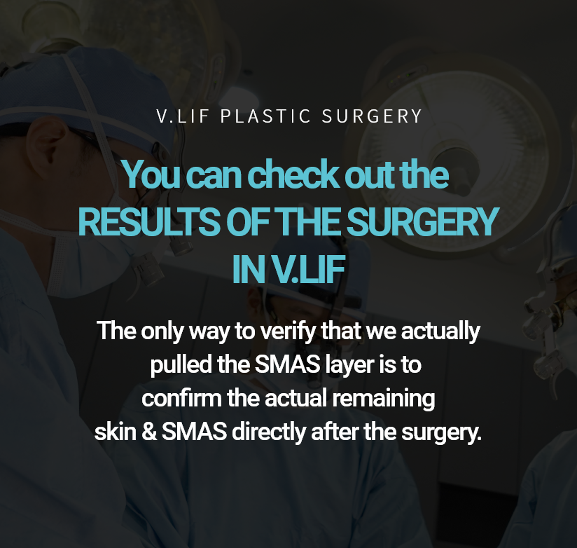 V.LIF PLASTIC SURGERY 수술결과를 확인 할 수 있는 빌리프 스마스층을 실제로 당겼는지 확인 할 수 있는 유일한 방법은 수술 후 당기고 남은 스마스 및 피부를 삭제한 것을 확인하는 것입니다.