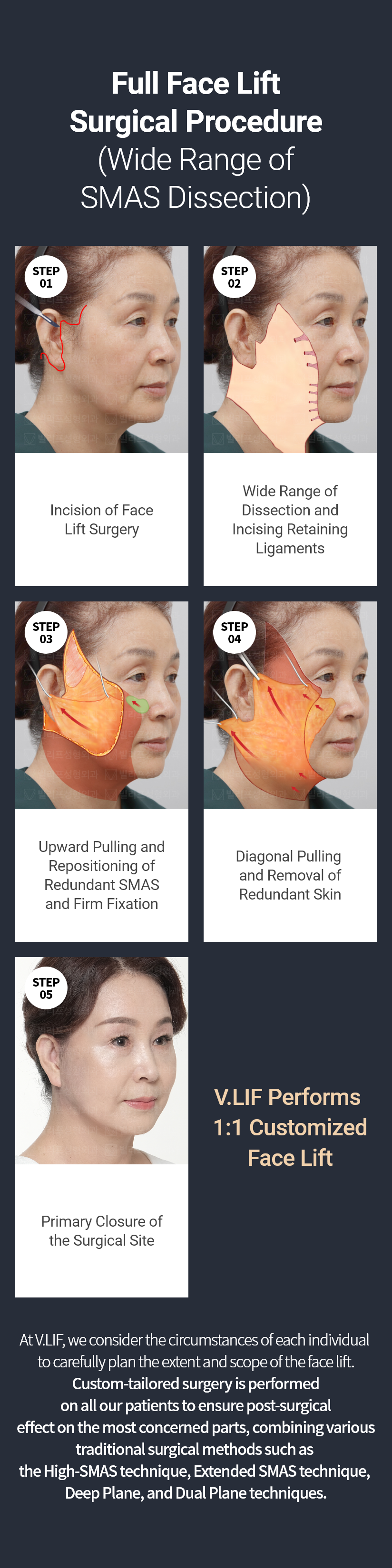 빌리프 - 빌리풀거상(안면거상술) 수술방법 STEP01 - 안면거상술 수술부위 절개, STEP02 - 광범위 박리와 유지인대 끊기, STEP03 - 아래로 처진 스마스를 위로 당겨 고정, STEP04 - 늘어지고 남은 피부를 당겨 절제, STEP05 - 수술부위 봉합 후 마무리 * 빌리프에서는 모든 사람을 똑같은 방식으로 수술하지 않습니다. * 빌리프에서는 개개인의 특성을 고려하여 박리의 범위와 가장 많이 처져있는 곳에 더 확실한 효과를 위하여 하이스마스, 익스텐디드스마스, 딥플레인, 듀얼플레인 등으로 한가지 수술법이 아닌 맞춤형 수술을 진행하고있습니다.