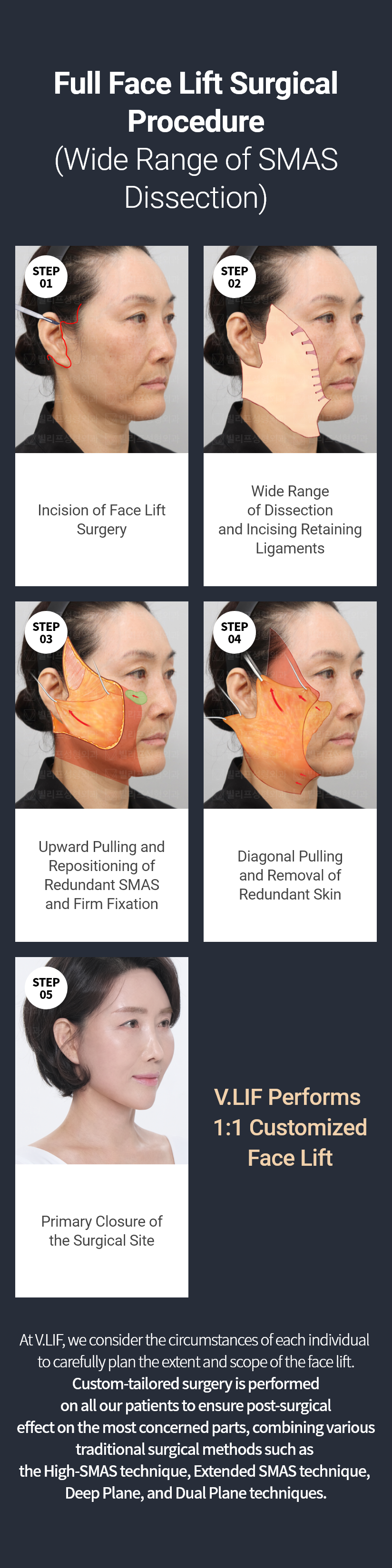 빌리프 - 빌리풀거상(안면거상술) 수술방법 STEP01 - 안면거상술 수술부위 절개, STEP02 - 광범위 박리와 유지인대 끊기, STEP03 - 아래로 처진 스마스를 위로 당겨 고정, STEP04 - 늘어지고 남은 피부를 당겨 절제, STEP05 - 수술부위 봉합 후 마무리 * 빌리프에서는 모든 사람을 똑같은 방식으로 수술하지 않습니다. * 빌리프에서는 개개인의 특성을 고려하여 박리의 범위와 가장 많이 처져있는 곳에 더 확실한 효과를 위하여 하이스마스, 익스텐디드스마스, 딥플레인, 듀얼플레인 등으로 한가지 수술법이 아닌 맞춤형 수술을 진행하고있습니다.