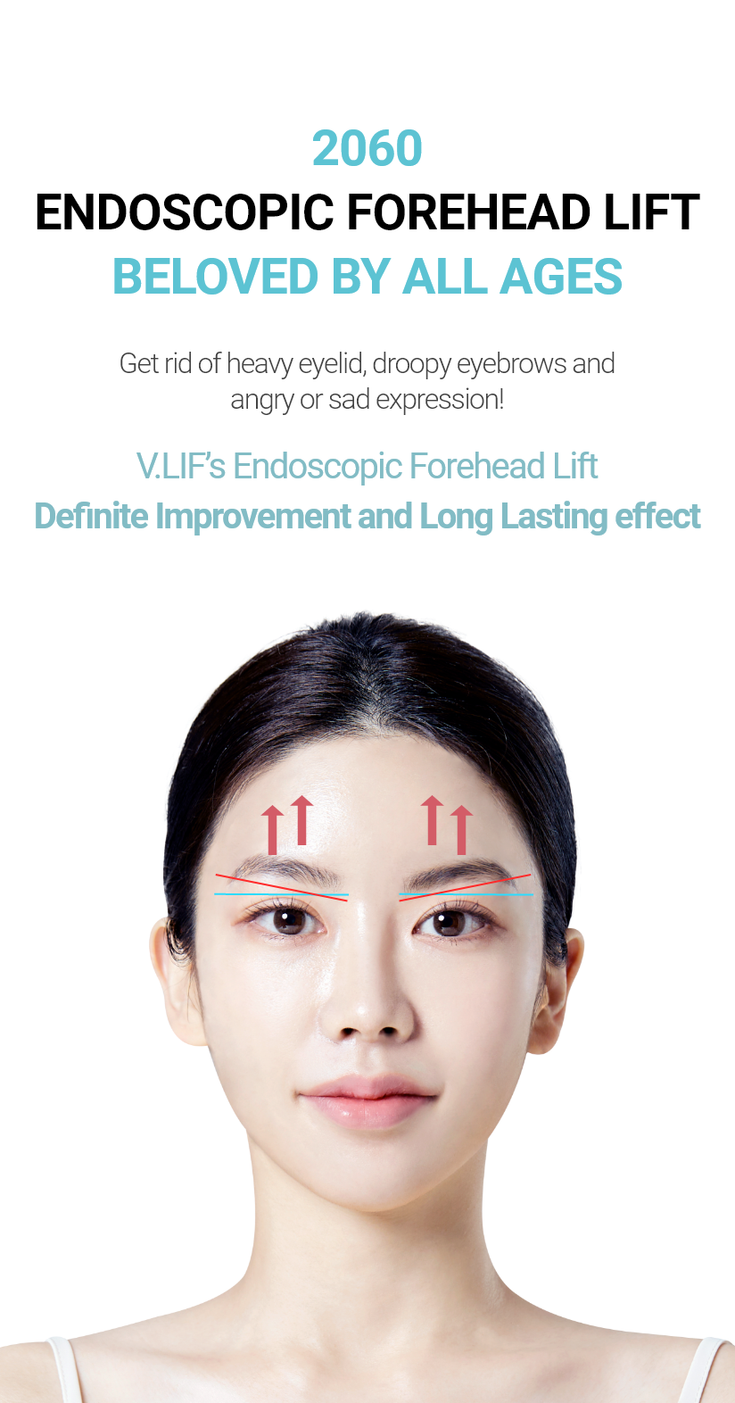 2060 ENDOSCOPIC FOREHEAD LIFT BELOVED BY ALL AGES Get rid of heavy eyelid, droopy eyebrows and angry or sad expression! V.LIF’s Endoscopic Forehead Lift Definite Improvement and Long Lasting effect