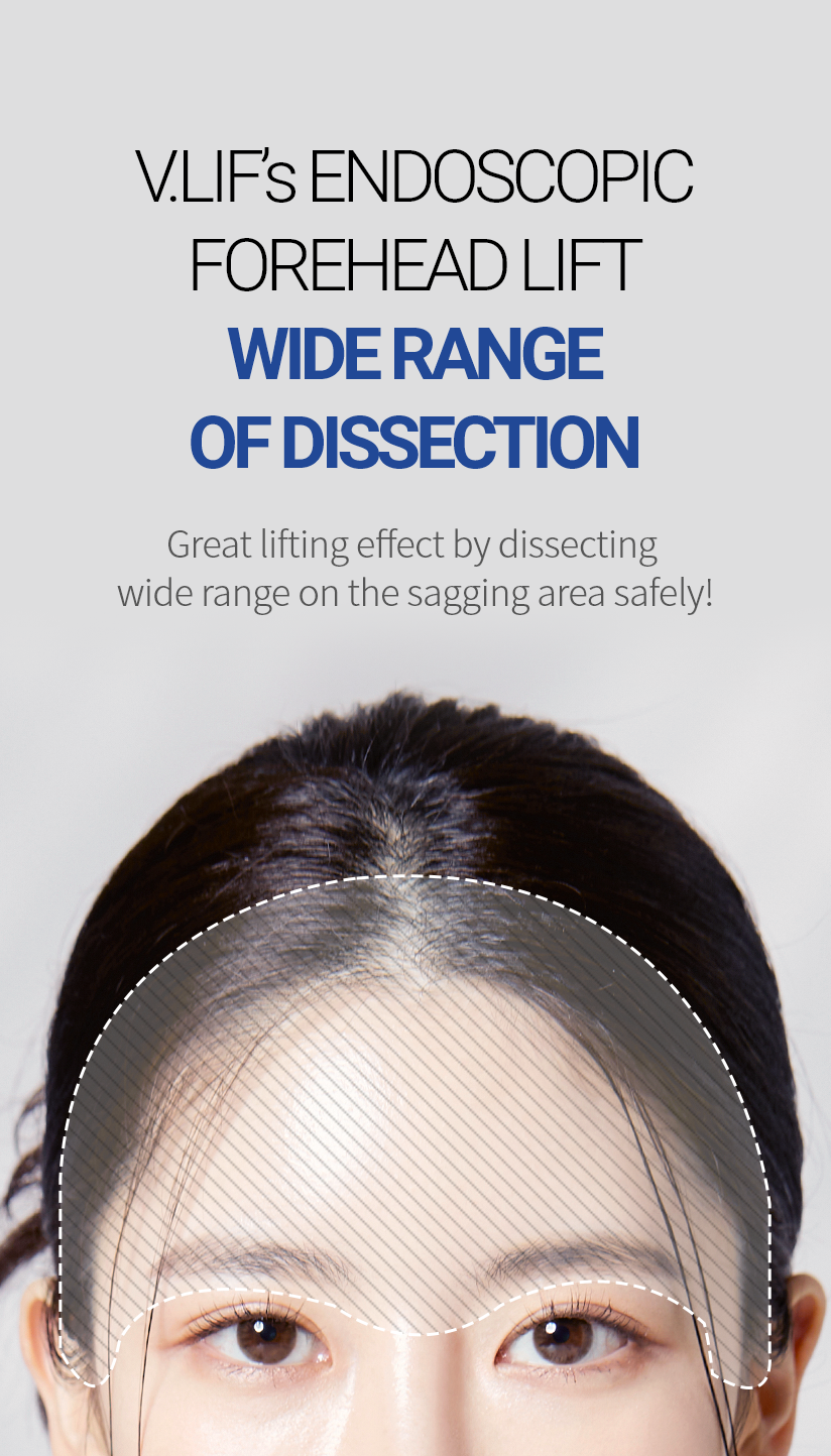 V.LIF’s ENDOSCOPIC FOREHEAD LIFT WIDE RANGE OF DISSECTION Great lifting effect by dissecting wide range on the sagging area safely!