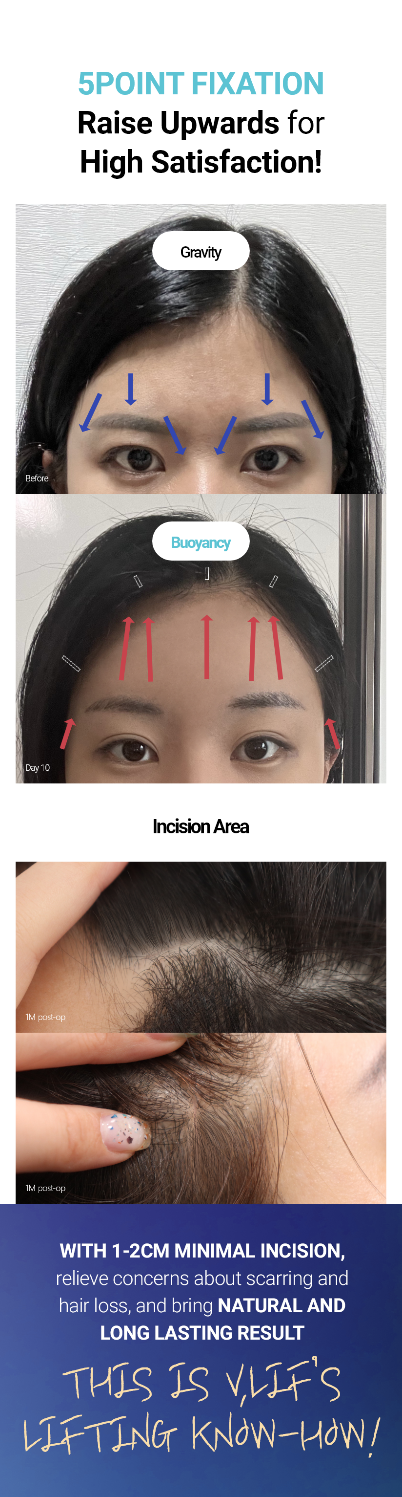 5POINT FIXATION Raise Upwards for High Satisfaction! WITH 1-2CM MINIMAL INCISION, relieve concerns about scarring and hair loss, and bring NATURAL AND LONG LASTING RESULT THIS IS V.LIF’S LIFTING KNOW-HOW!