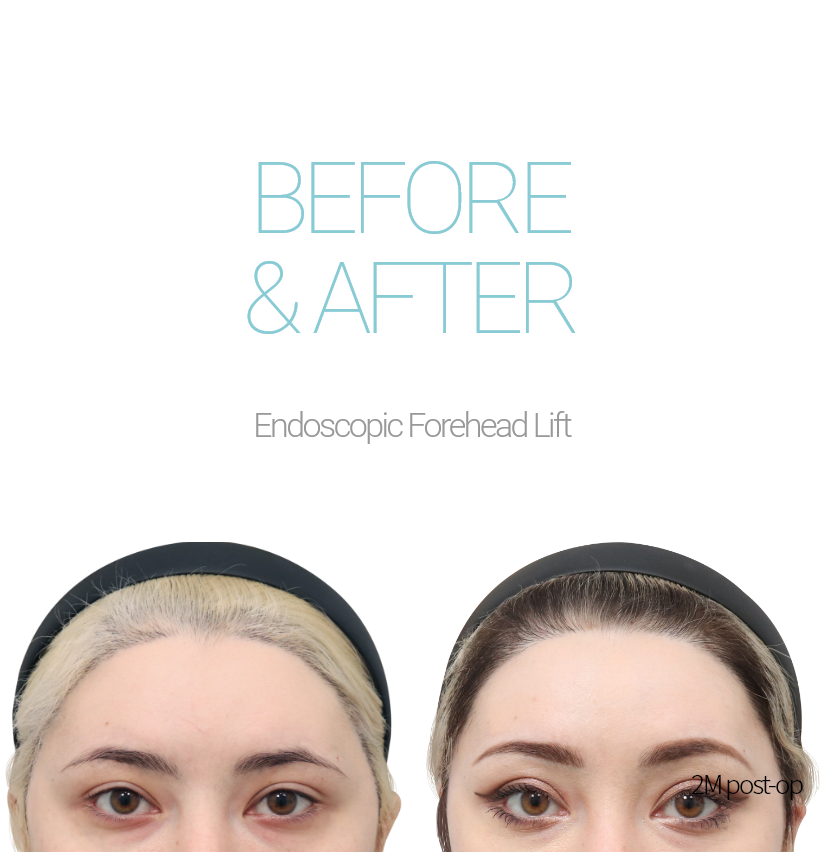 BEFORE & AFTER Endoscopic Forehead Lift