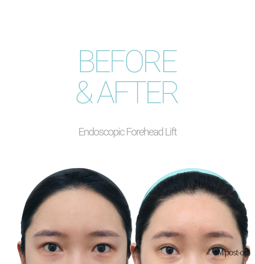 BEFORE & AFTER Endoscopic Forehead Lift