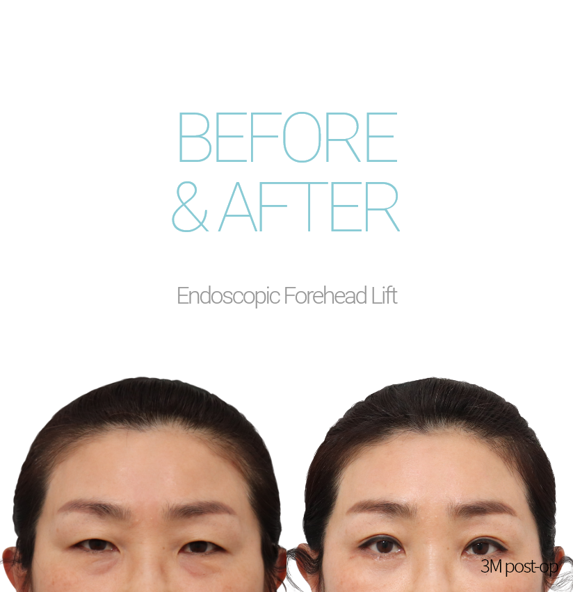 BEFORE & AFTER Endoscopic Forehead Lift