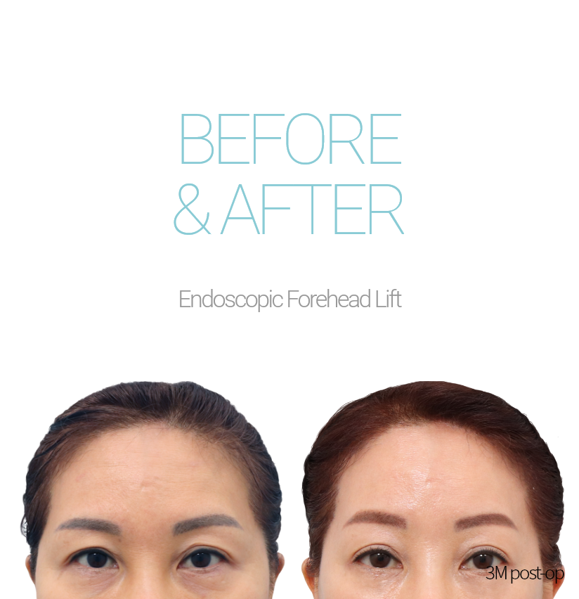 BEFORE & AFTER Endoscopic Forehead Lift