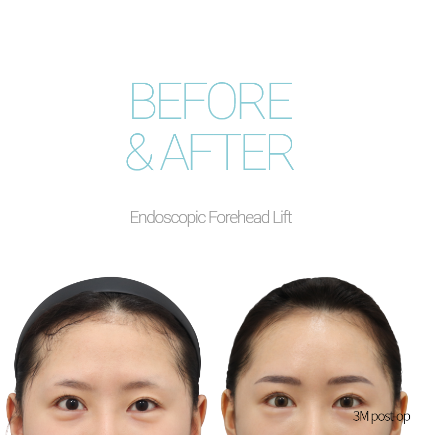 BEFORE & AFTER Endoscopic Forehead Lift