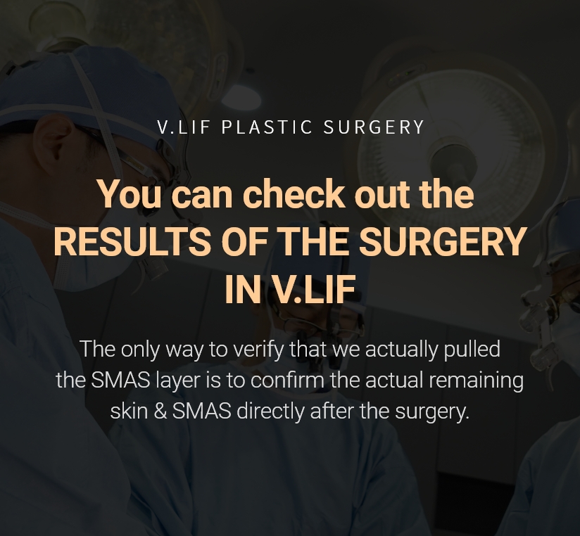 V.LIF PLASTIC SURGERY 수술결과를 확인 할 수 있는 빌리프 모두가 스마스 리프팅이라 말합니다. 실을 사용하지않는, 피부만 삭제하지않는 진짜 스마스 리프팅만 시술합니다.