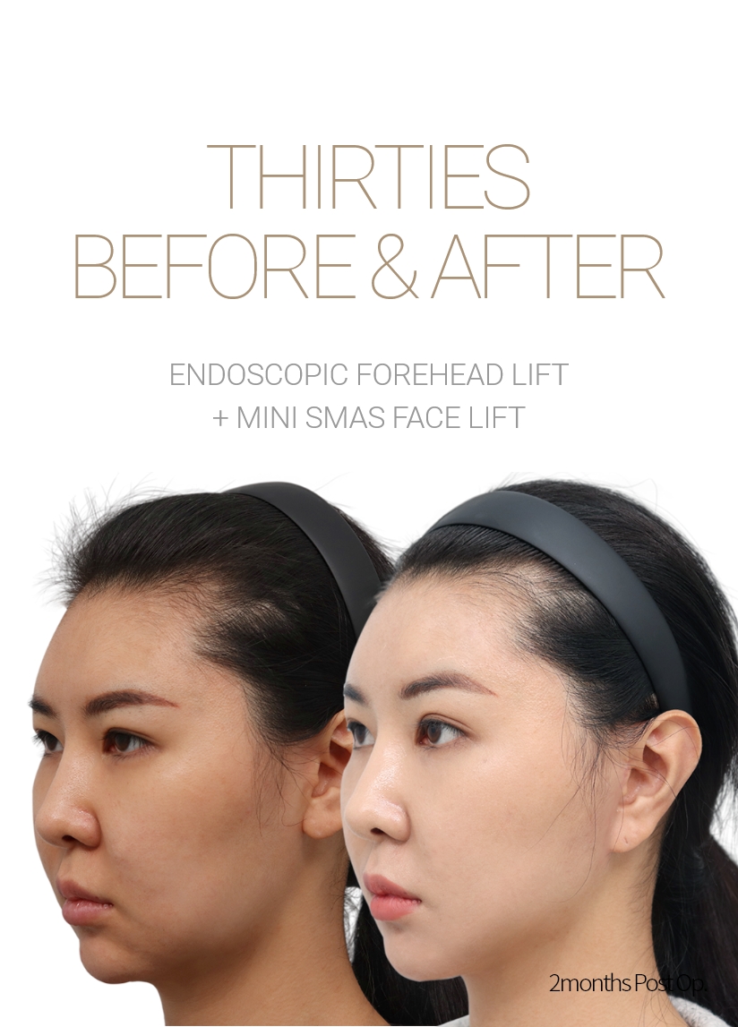 THIRTIES BEFORE & AFTER 픽업 내시경이마거상술 + 스마스리프팅