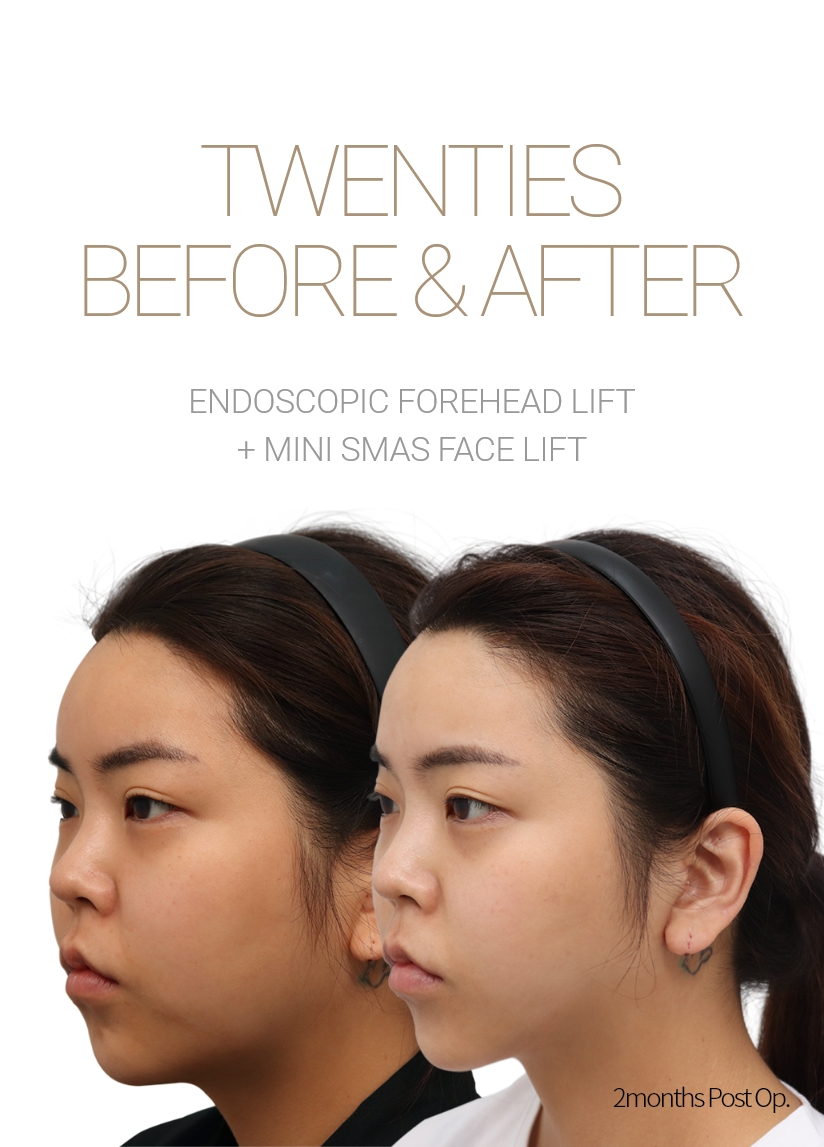 THIRTIES BEFORE & AFTER 픽업내시경이마거상 + 미니거상