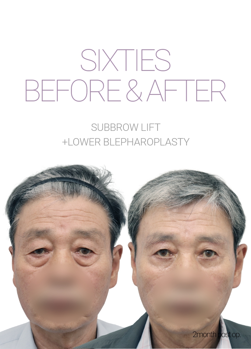 sixties BEFORE & AFTER 눈썹하거상 + 하안검