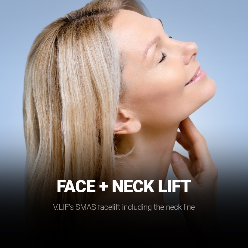 FACE + NECK LIFT V.LIF's SMAS facelift including the neck line