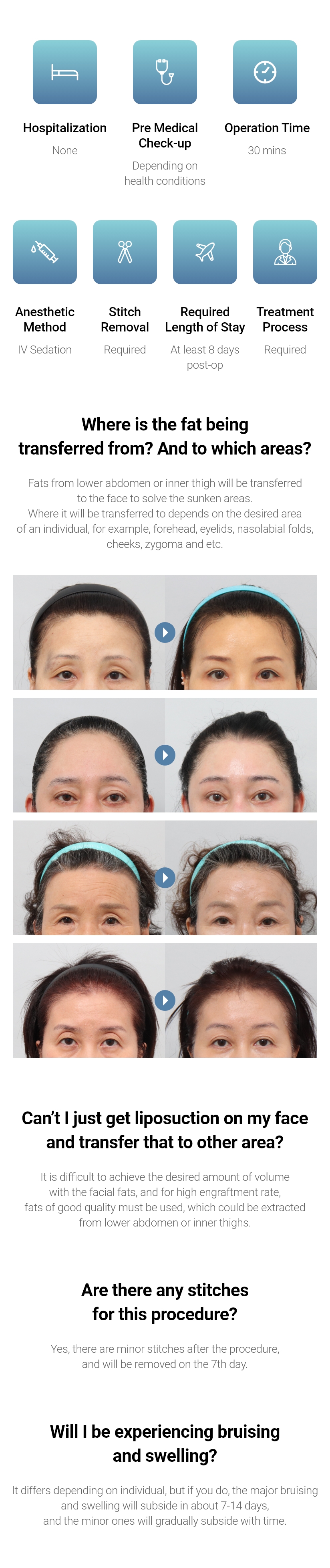 Hospitalization None, Anesthetic Method Depending on health conditions, Operation Time 1~2 hours, Anesthetic Method IV Sedation, Stitch Removal Required, Required Length of Stay At least 7 days post-op, Treatment Process Required / Where is the fat being transferred from? And to which areas? - Fats from lower abdomen or inner thigh will be transferred to the face to solve the sunken areas. Where it will be transferred to depends on the desired area of an individual, for example, forehead, eyelids, nasolabial folds, cheeks, zygoma and etc. / Can’t I just get liposuction on my face and transfer that to other area? - It is difficult to achieve the desired amount of volume with the facial fats, and for high engraftment rate, fats of good quality must be used, which could be extracted from lower abdomen or inner thighs. / Are there any stitches for this procedure? - Yes, there are minor stitches after the procedure, and will be removed on the 7th day. / Will I be experiencing bruising and swelling? - It differs depending on individual, but if you do, the major bruising and swelling will subside in about 7-14 days, and the minor ones will gradually subside with time.